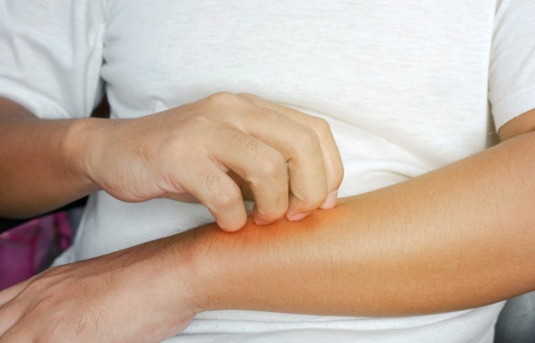 dermatitis en brazo por alergias