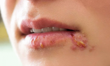 lesiones de herpes bucal