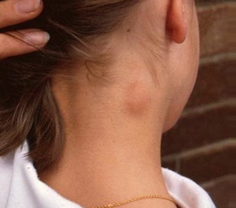 persona con nódulo cervical
